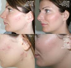 clear-acne-in-skin